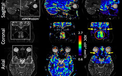 The X-SPENdables: Addressing the Most Challenging Tissues in Magnetic Resonance
