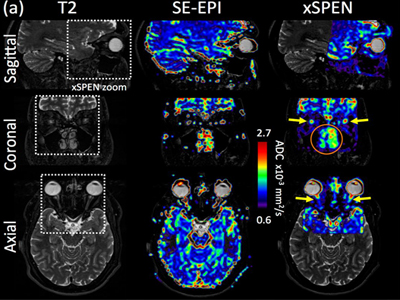 The X-SPENdables: Addressing the Most Challenging Tissues in Magnetic Resonance