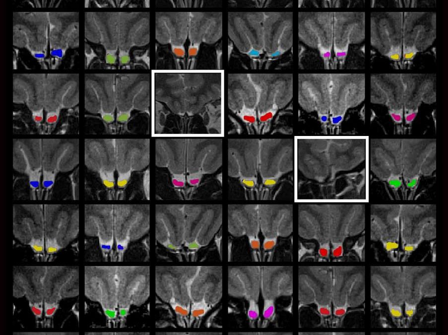 An Exception to the Rule: An Intact Sense of Smell without a Crucial Olfactory Brain Structure