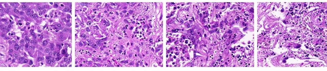 A New Approach to Tailoring Cancer Therapy: Tapping into Signaling Activities in Cancer Cells