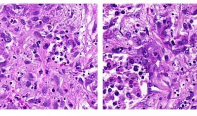 A New Approach to Tailoring Cancer Therapy: Tapping into Signaling Activities in Cancer Cells