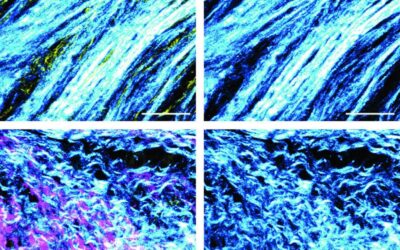 Weizmann Institute scientists have discovered how mutations in the BRCA genes, particularly prevalent among Ashkenazi Jews, lead to recruitment of cellular “assistants” in pancreatic cancer